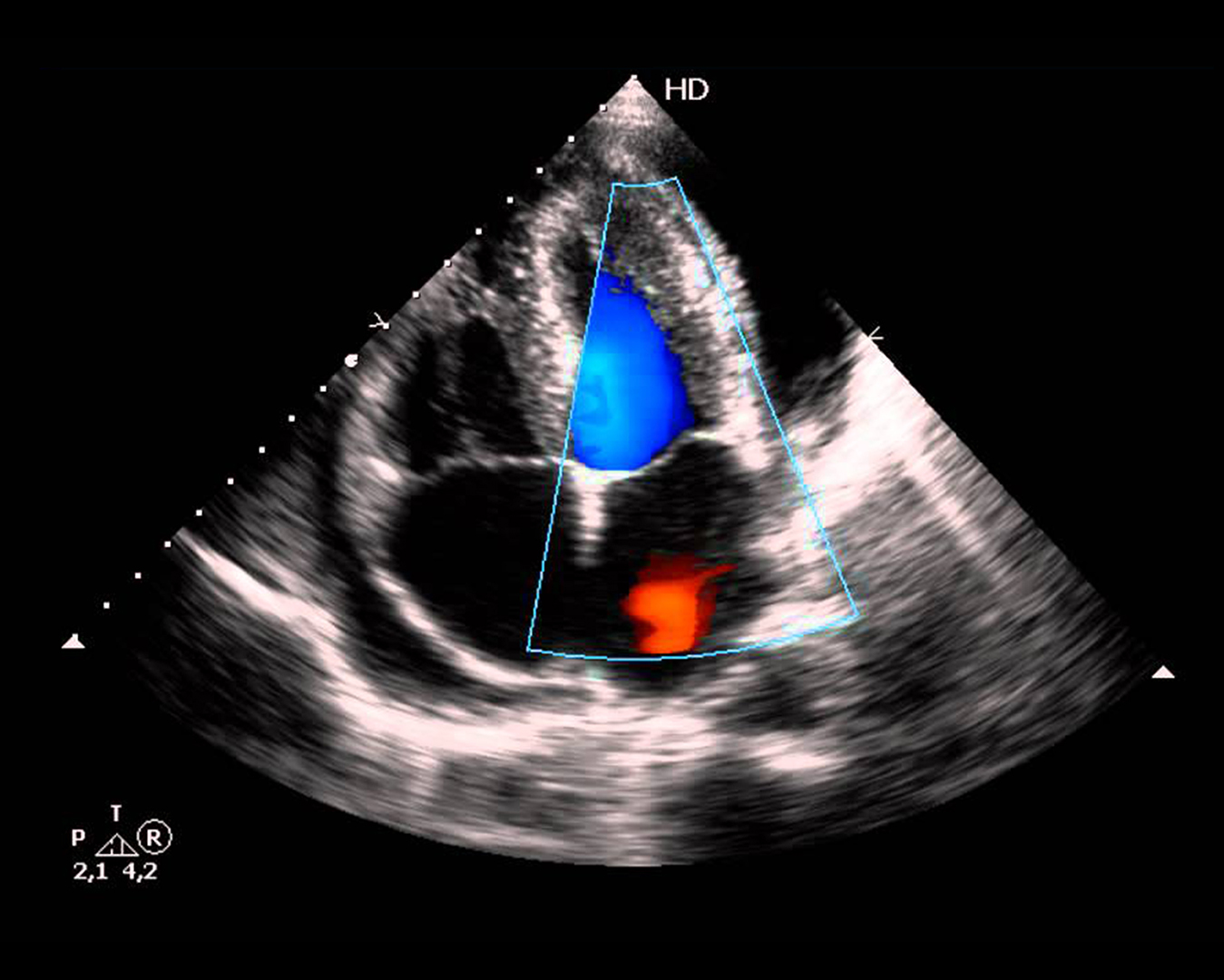 Lavoisier - Teste ergométrico, cintilografia miocárdica, ecocardiograma,  holter, mapa, eletrocardiograma, angiotomografia coronariana, escore de  cálcio e ressonância cardíaca. Aqui no Lavoisier Angélica I você encontra  diversos de exames cardiológicos